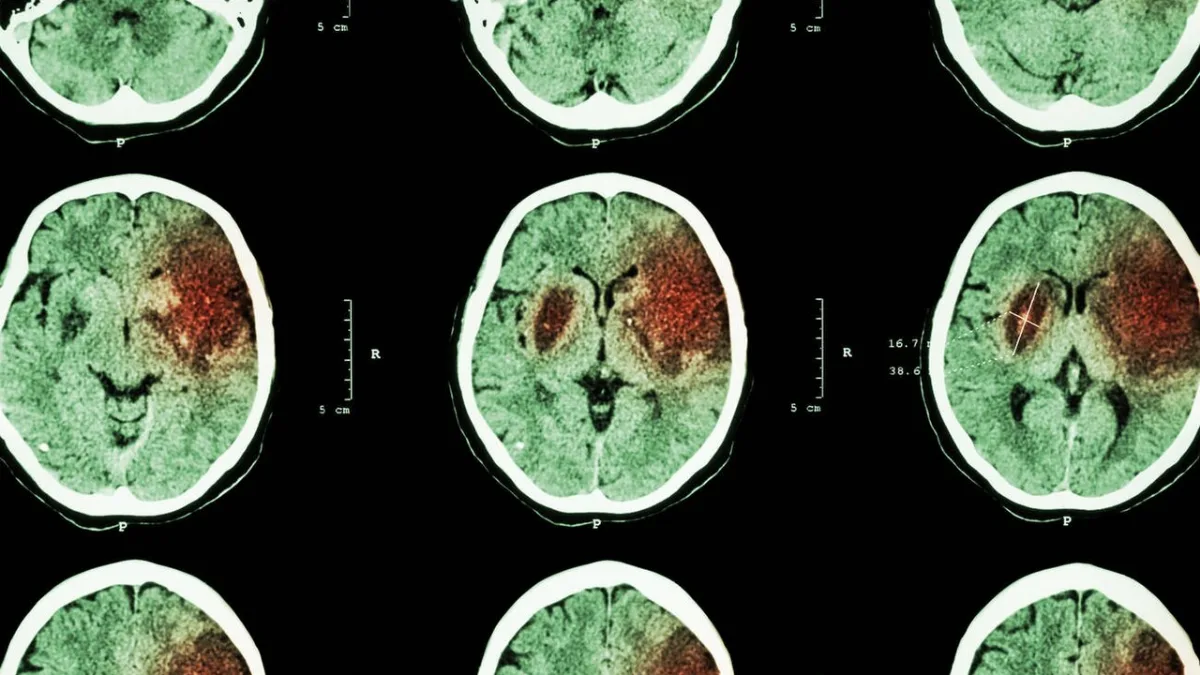 Tomografía craneal que muestra una lesión por ictus en el cerebro